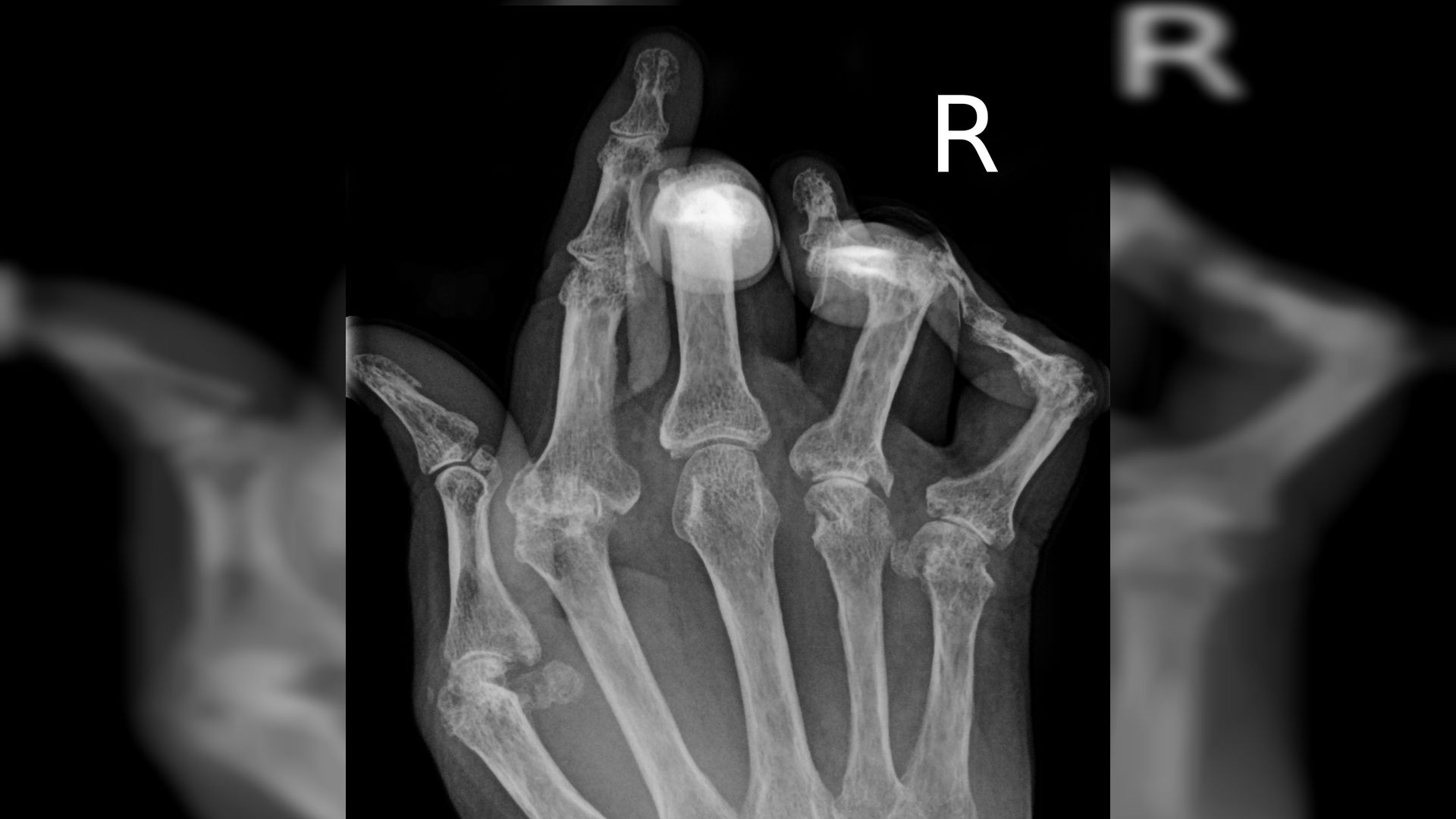Ревматоидный артрит кисти рентгенограмма
