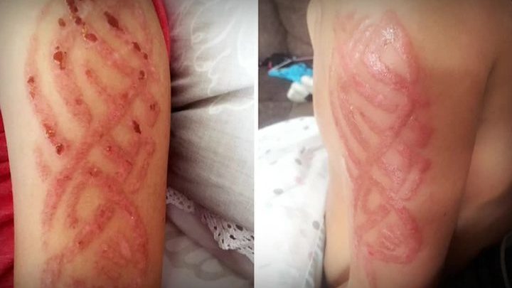 Ожоги на детской коже Ожоги на детской коже