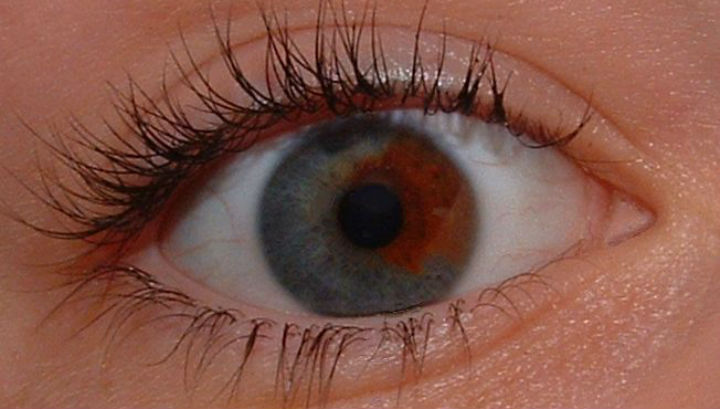 Глаза голубые и карие глаза фото до и после