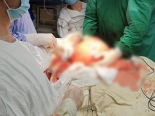 Московские врачи удалили из живота пациента гигантскую 12-килограммовую опухоль