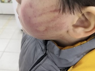 На Ставрополье начата проверка по факту избиения ребенка в детском саду