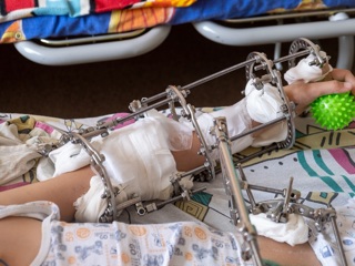 Собрали по кусочкам оторванную руку: челябинские врачи спасли ребенка, выпавшего из окна