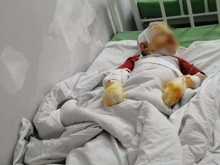 Четырехлетний мальчик получил серьезные ожоги во время прогулки с отцом