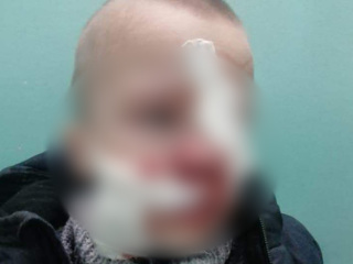 Сбежавший хаски вцепился в лицо ребенку в Коломне