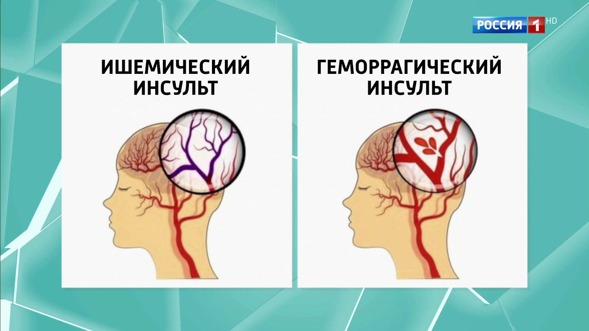 Инфаркт и инсульт. Инсульт и инфаркт. Инсульт сильная головная боль. Сигналы инсульта. Как происходит инсульт видео.