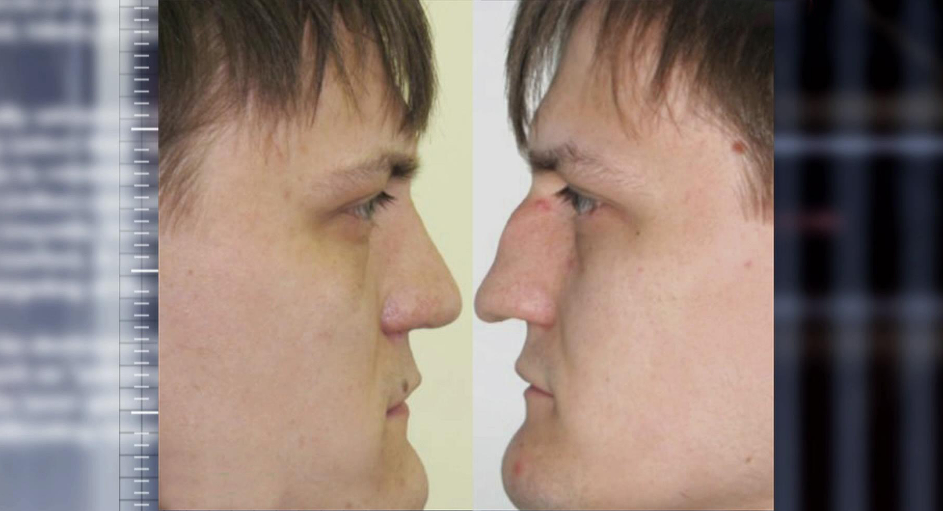 Прямой нос с горбинкой у мужчин. Ринопластика до и после мужчины.