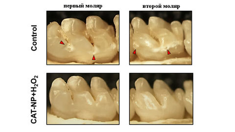 Перекись водорода и наночастицы нанесут сокрушительный удар по кариесу