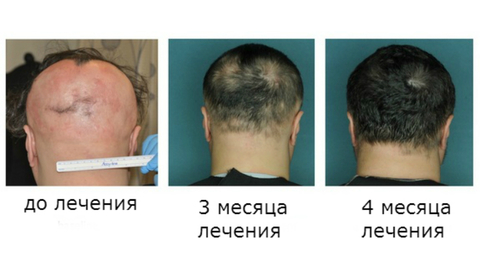 Новый препарат поможет вырастить волосы при облысении