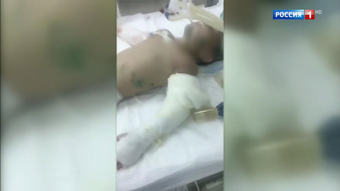 Перенесшая ампутацию изувеченная девочка удивила детского омбудсмена