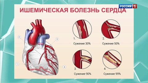 Медики назвали признаки, указывающие на скорый инфаркт