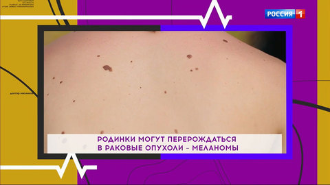 Не рак ли это? Доктор Мясников рассказал, как распознать опасные родинки