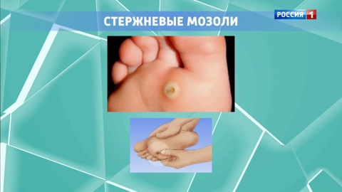 Как избежать мозолей в жару и что делать с натоптышами: советы ортопеда