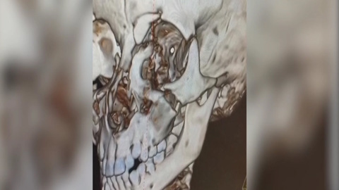 Кузбасские хирурги спасли мальчика, на которого упали футбольные ворота