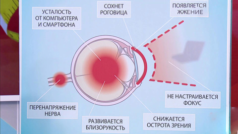Компьютерный зрительный синдром: как спасти глаза