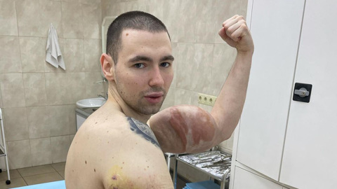 "Руки-базуки" показал трицепс, из которого удалили синтол