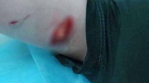 В Михайловске собака напала на 5-летнего мальчика