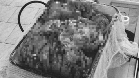 В Набережных Челнах врачи вырезали пациентке опухоль весом 3,5 кг