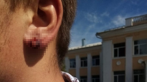 Школьник утверждает, что из-за серьги директор порвал ему ухо