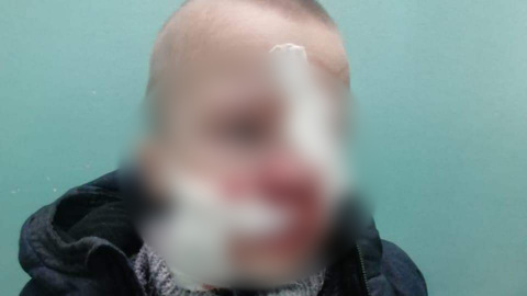 Сбежавший хаски вцепился в лицо ребенку в Коломне