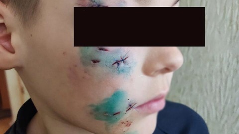 Собака разодрала ребенку лицо на детской площадке под Тулой