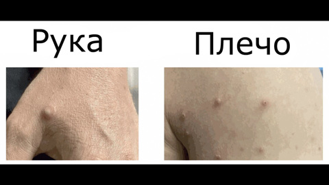 Каковы новые клинические симптомы оспы обезьян?