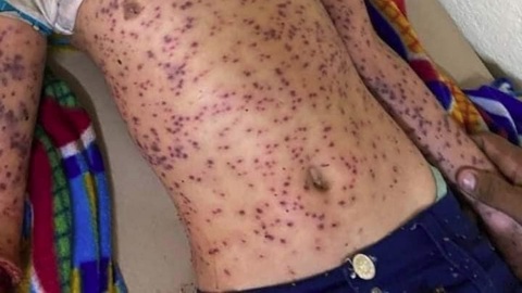 Шесть человек погибли в результате нападения пчел после ДТП с автобусом
