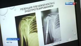 Казанские врачи спасли руку женщины, ее не пришлось ампутировать