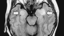 Повреждение мозга у 58-летней пациентки показано стрелками.
