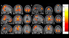 Исследователи сканировали мозг студентов до и после восьми недель занятий медитацией.