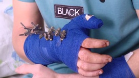 На Кубани врачи пришили мужчине отрубленную топором руку