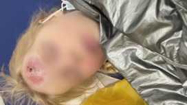 4-летняя москвичка попала в реанимацию после наезда электросамоката