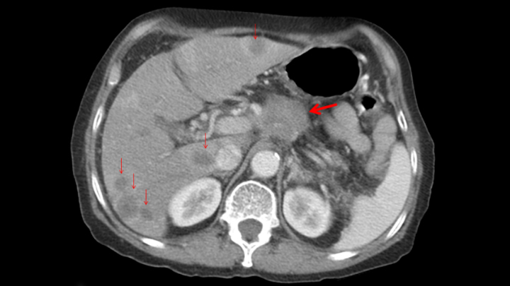 КТ брюшной полости, демонстрирующая рак поджелудочной железы (жирная красная стрелка) с метастазами в печень (маленькие красные стрелки)