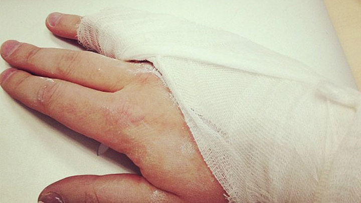 Алексей Навальный сломал мизинец