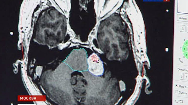 Нейрохирургия коновалов. Институт Бурденко операционные. Бурденко нейрохирургия. НИИ Бурденко Москва гамма нож. НИИ Бурденко фото.