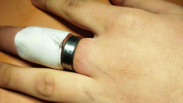 Застряло кольцо на пальце