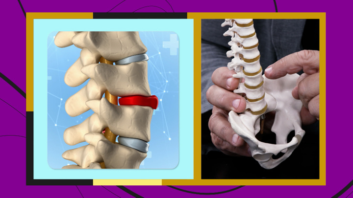 Что важно знать, если у вас обнаружили грыжу межпозвонкового диска